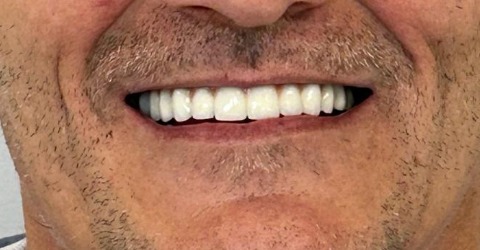 After_all-on_4_porcelain-fused-to-metal-teeth