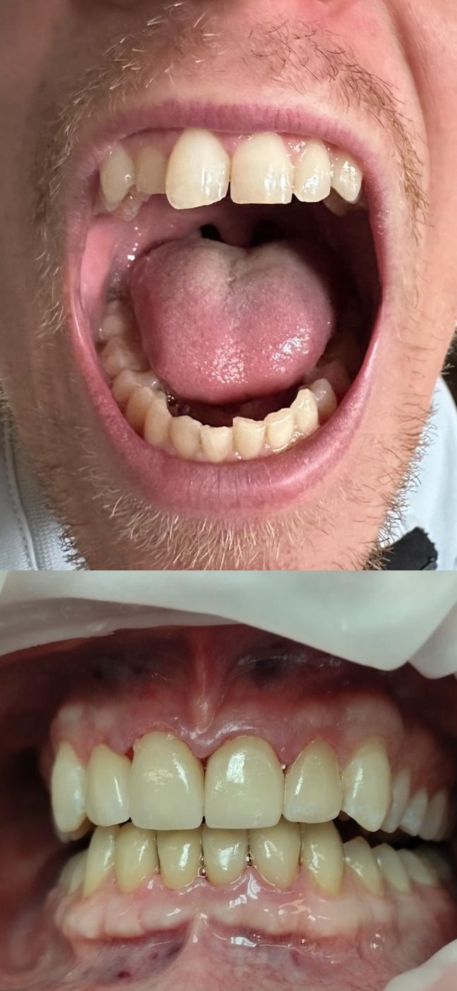before - after teeth with E-max porcelain veneers