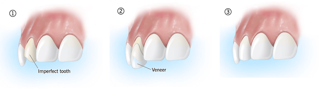 How are veneers done?