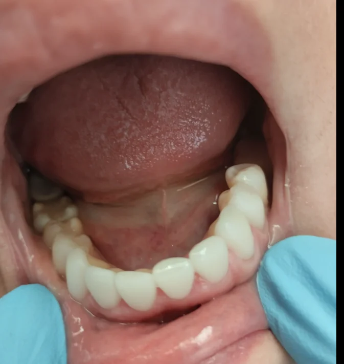 bottom teeth after E-max porcelain veneer treatment