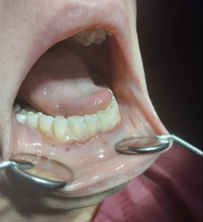 bottom teeth before veneer treatment