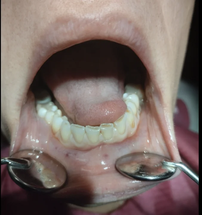 teeth before veneer treatment