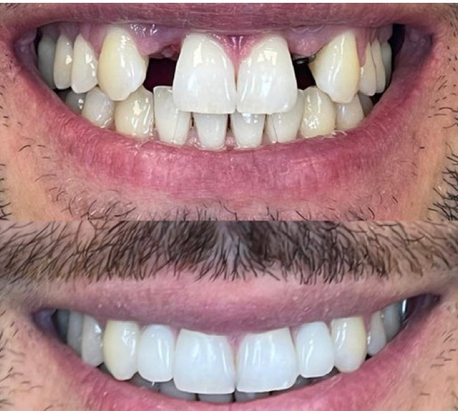 Before and After Zirconia Crowns - smile transformation in Budapest