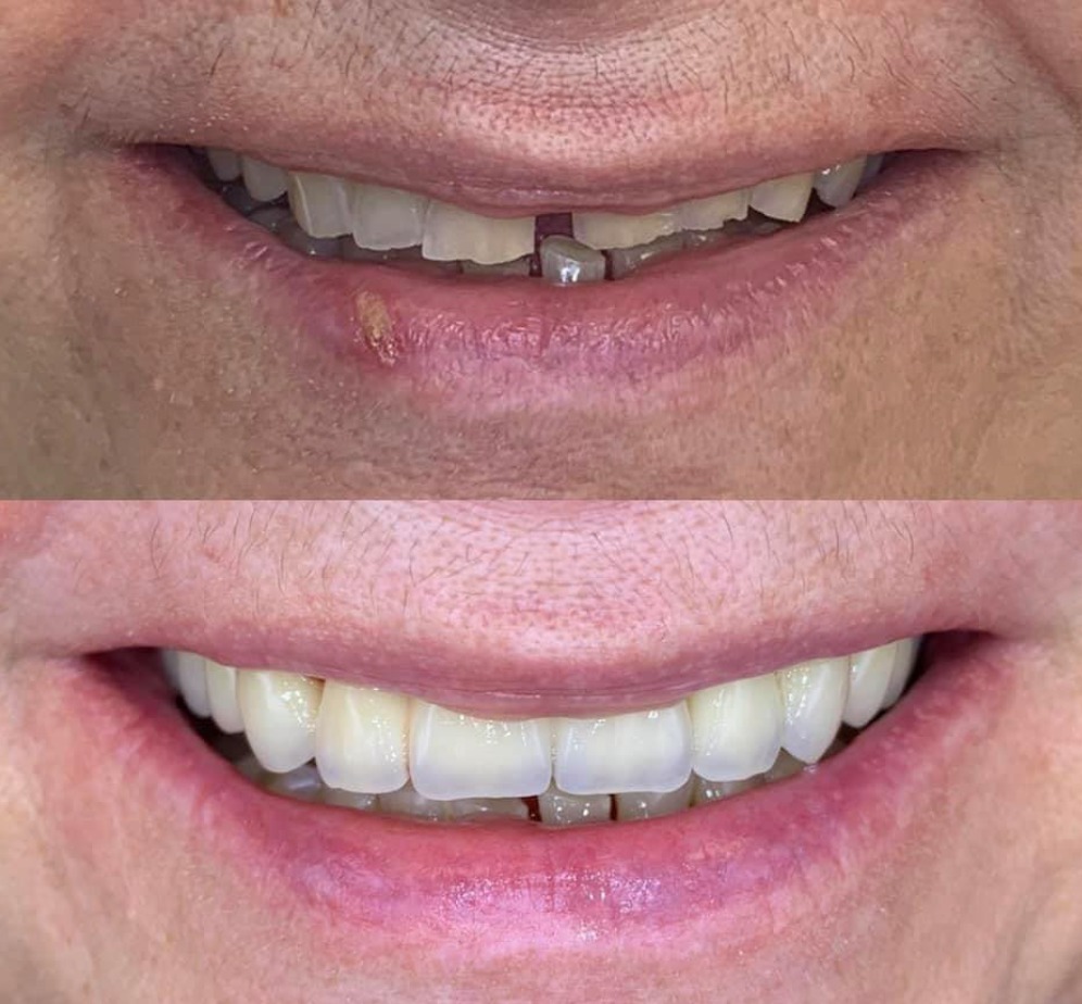 Smile Transformation – Before and After Zirconia Crowns