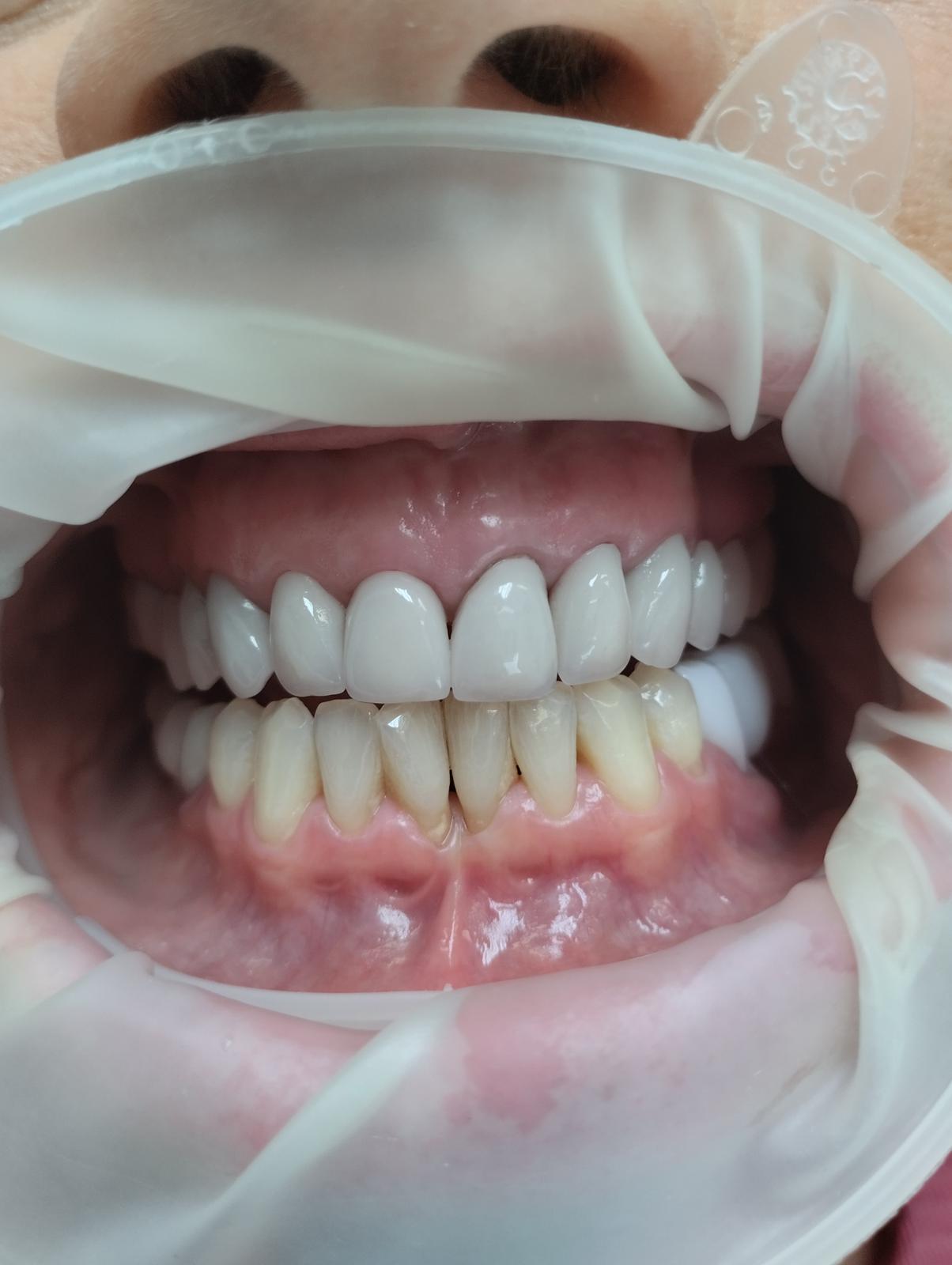 Teeth before smile makeover