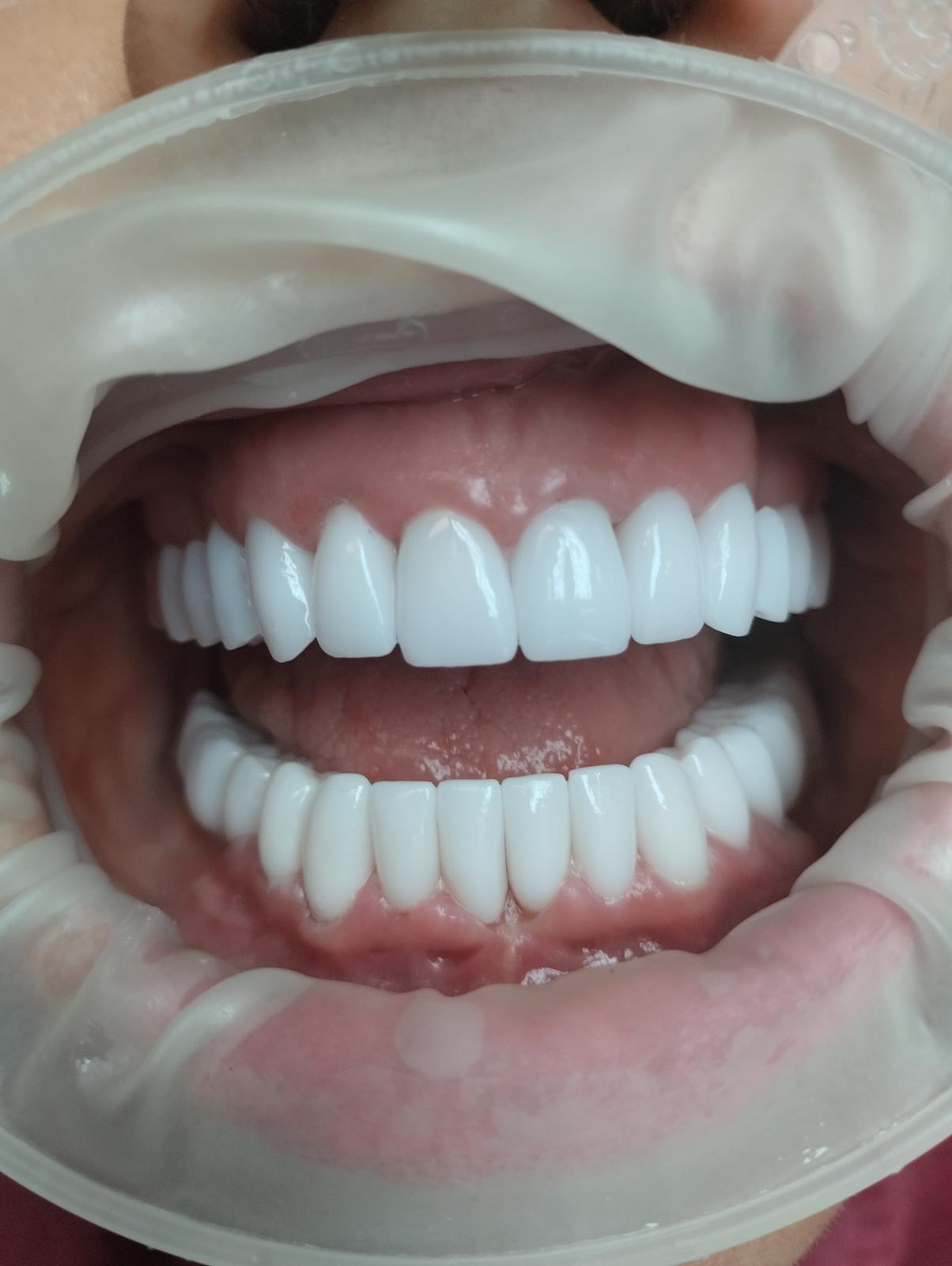 zirconia teeth in Budapest afetr smile makover