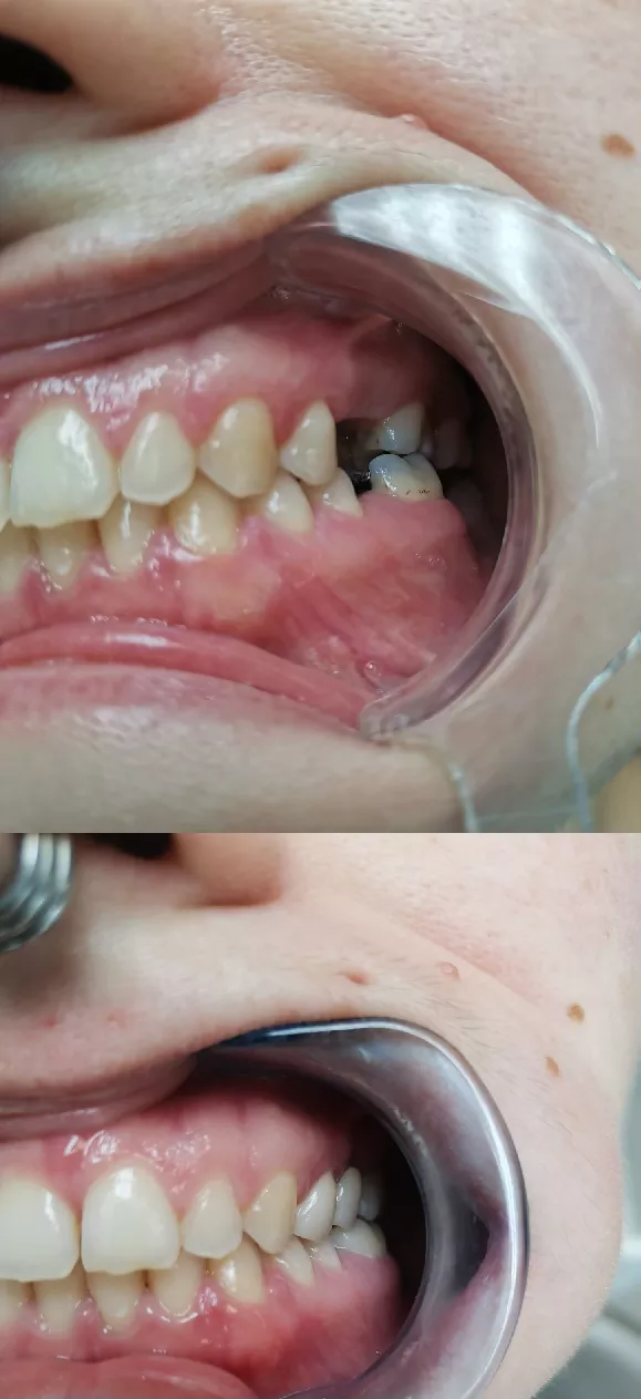 Dental Bridge