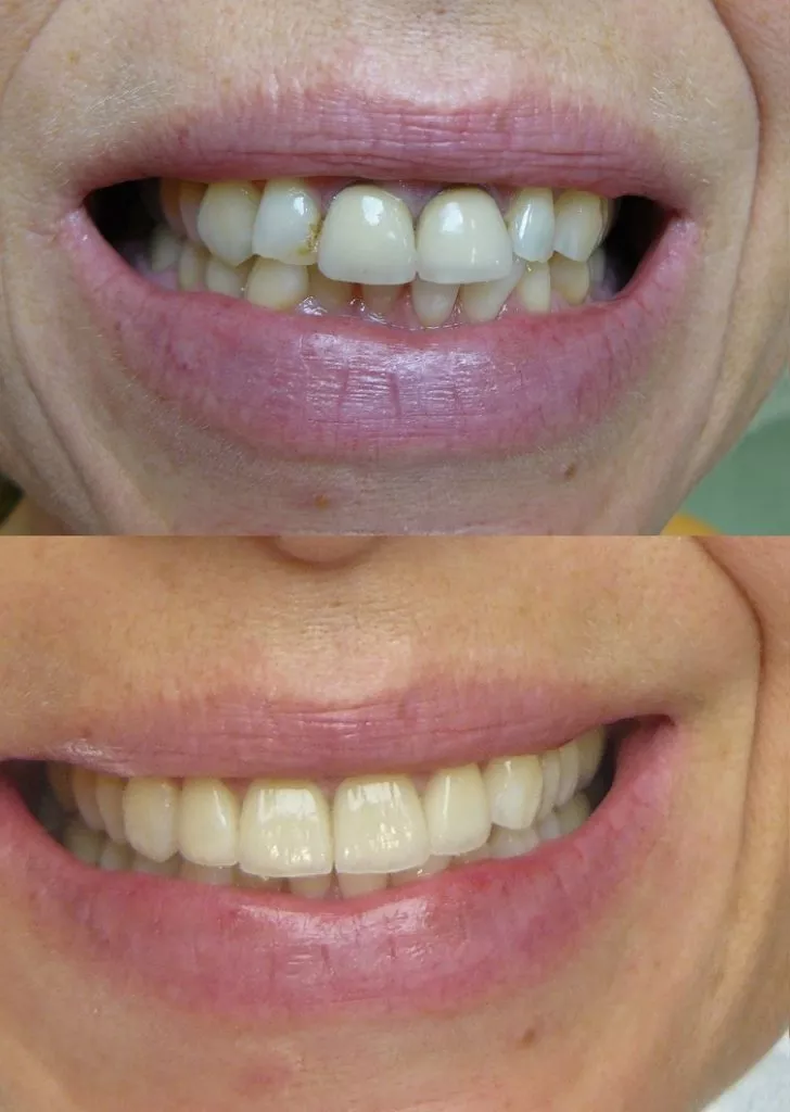 Dental Veneers Hungary