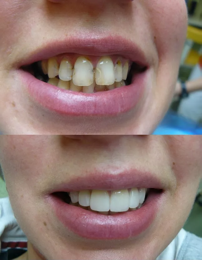 Dental Veneers Hungary