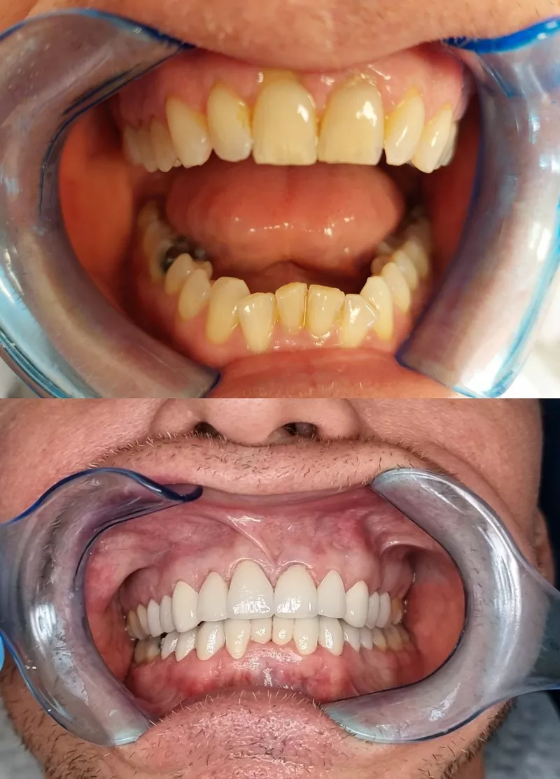 Dental Veneers Hungary