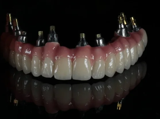 Dental Implant Centre