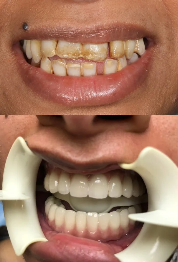 all-on-6 dental implants in hingary