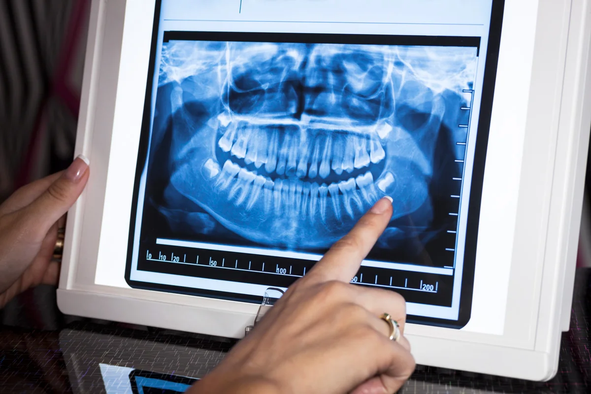 A panoramic x-ray that is the basis of a dental medical examination.